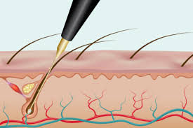 electrolysis Image